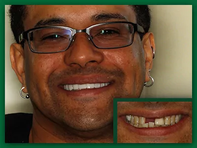 Another patient showing off new porcelain veneers and crowns in Jefferson City.