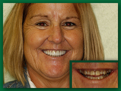 Dental veneer before and after photo.