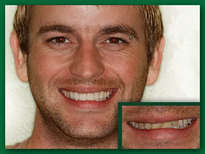 Dental crown before and after photo