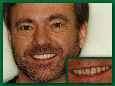 Patient from Jefferson City shows off a combination of nice looking dental crowns and veneers.