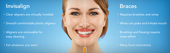 Diagram showing metal braces vs. Invisalign clear braces available in Jefferson City.