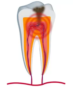 stop a toothache in Jefferson City with root canal therapy