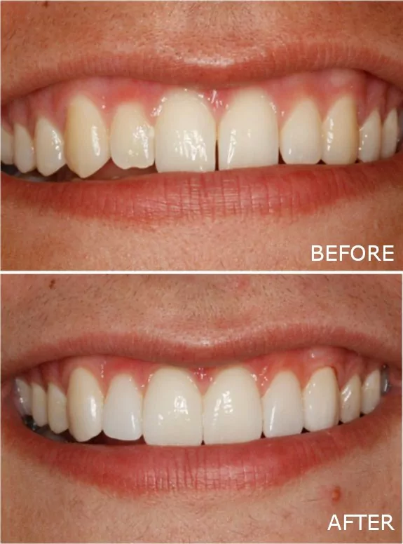 Before and after photo showing the dramatic improvement that porcelain veneers can make for Jefferson City patients.