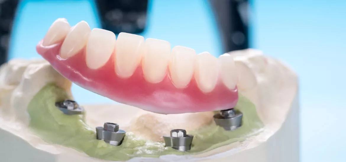 lower dentures in Jefferson City