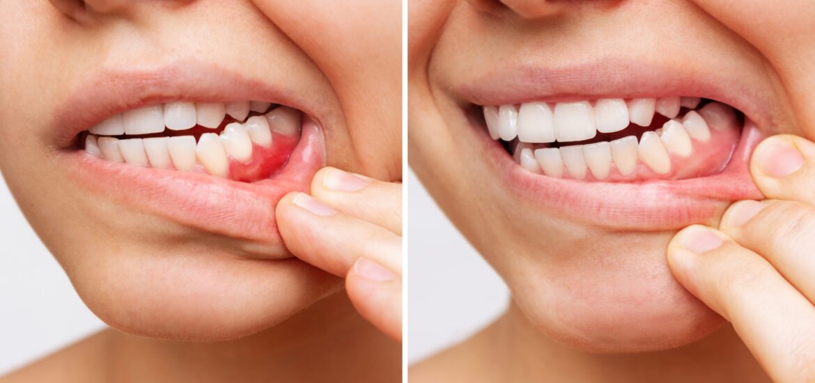 side by side cropped photo of gum disease progression