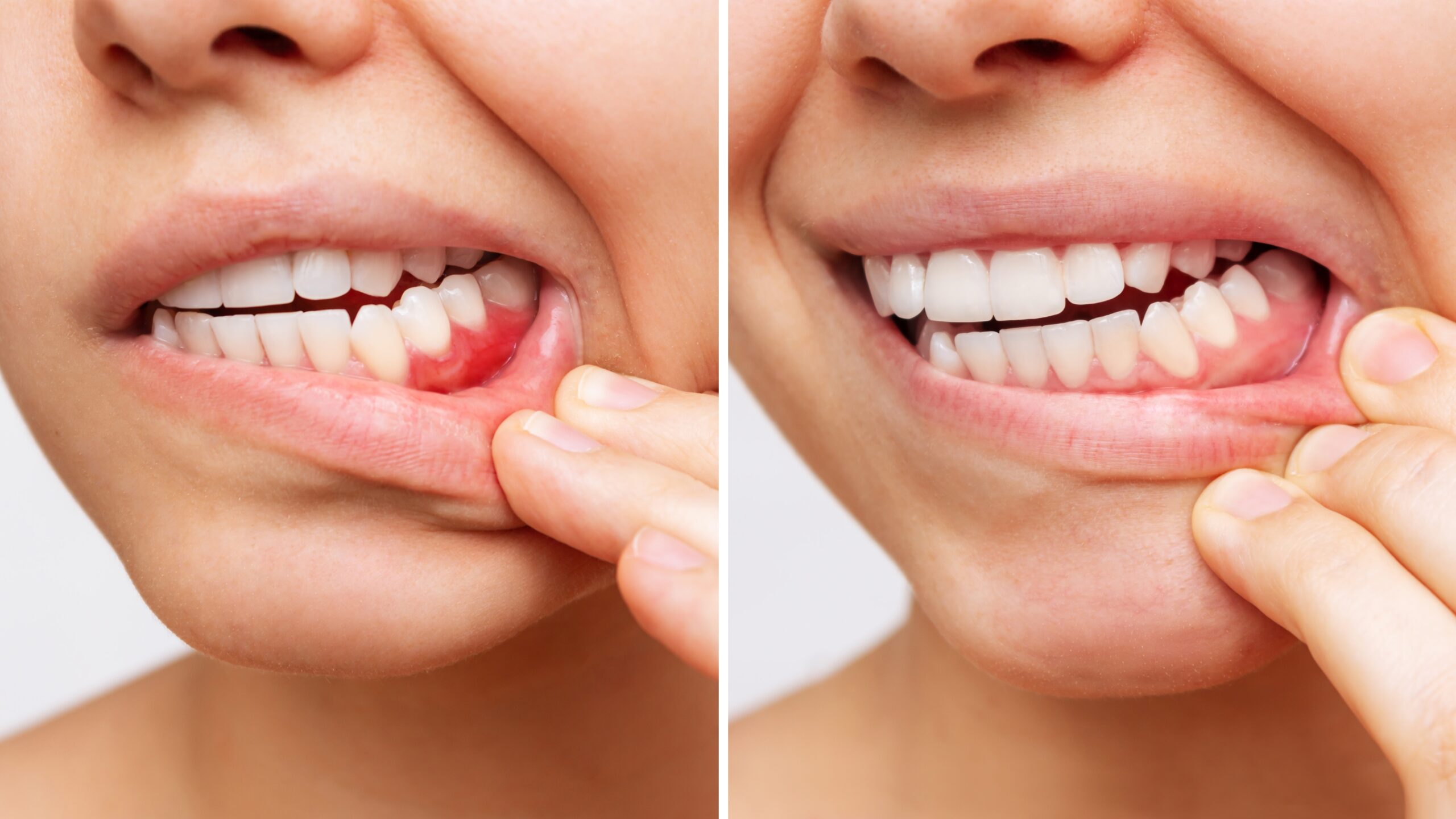 side by side cropped photo of gum disease progression