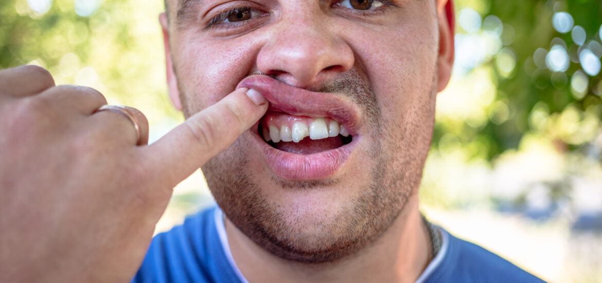 man in a blue shirt exposing his chipped tooth