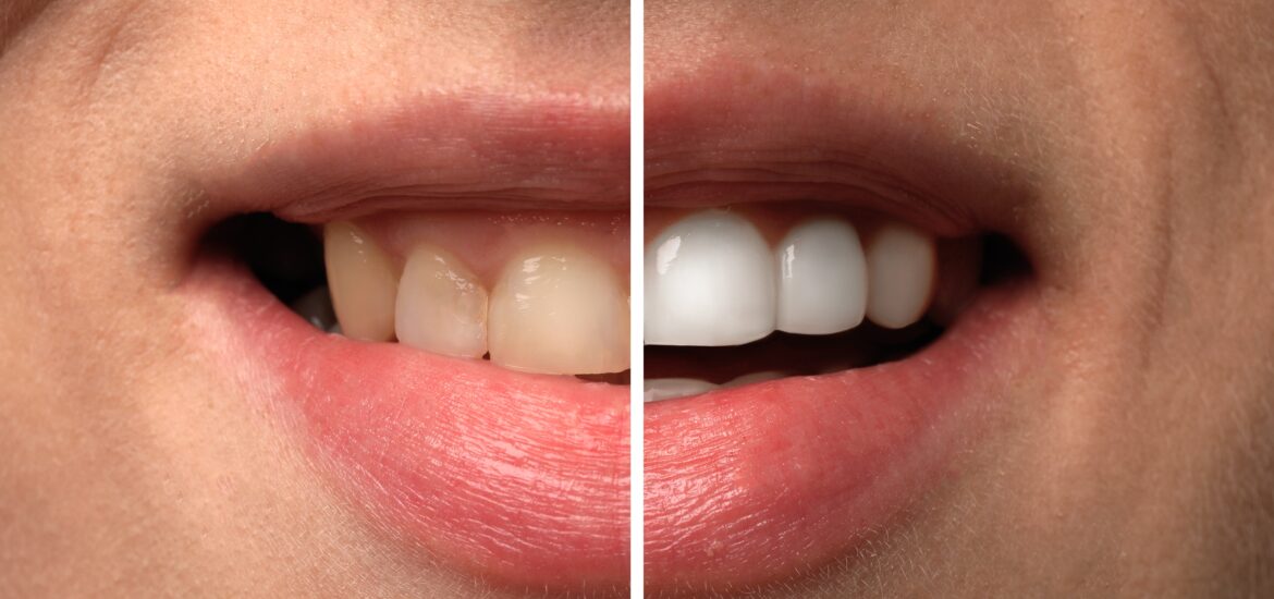 side by side of yellow teeth and white teeth, cosmetic treatment for tooth discoloration